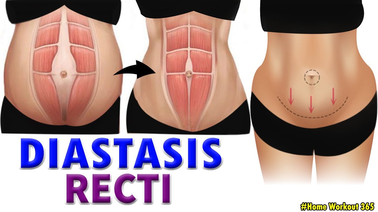 SIMPLE DIASTASIS RECTI WORKOUT | FIX YOUR TUMMY AFTER PREGNANCY