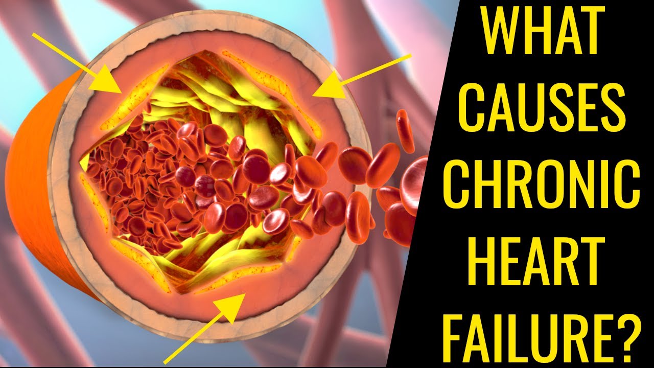 What Is Chronic Heart Failure And How Can You Prevent It?